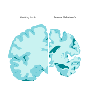 Comparison between a normal looking brain and a brain with Alzheimer’s